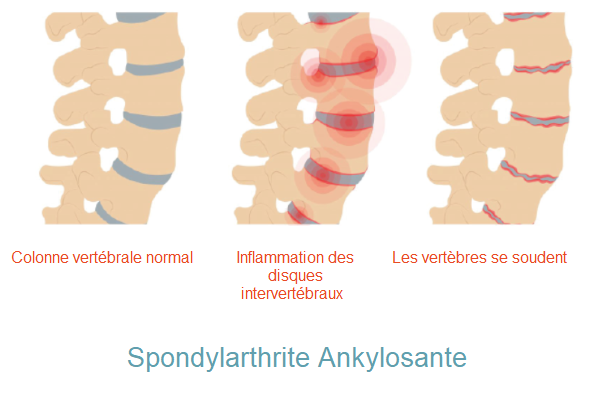 Institut-pour-l-ergodynamie-maladie-autoimmune-spondylarthrite-ankylosante